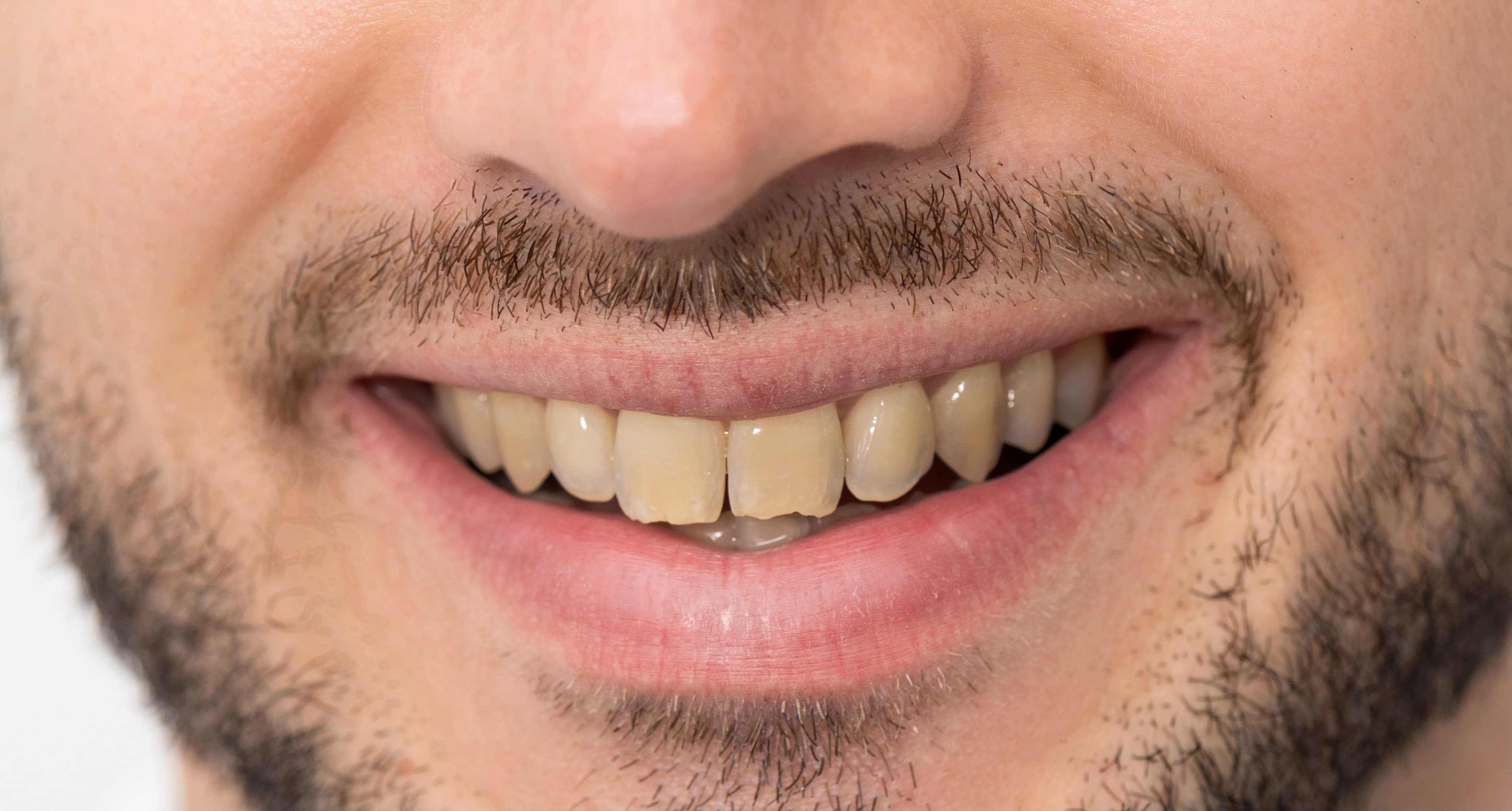 Before: Clinical illustration showing potential tooth whitening results of 6-8 shades improvement.