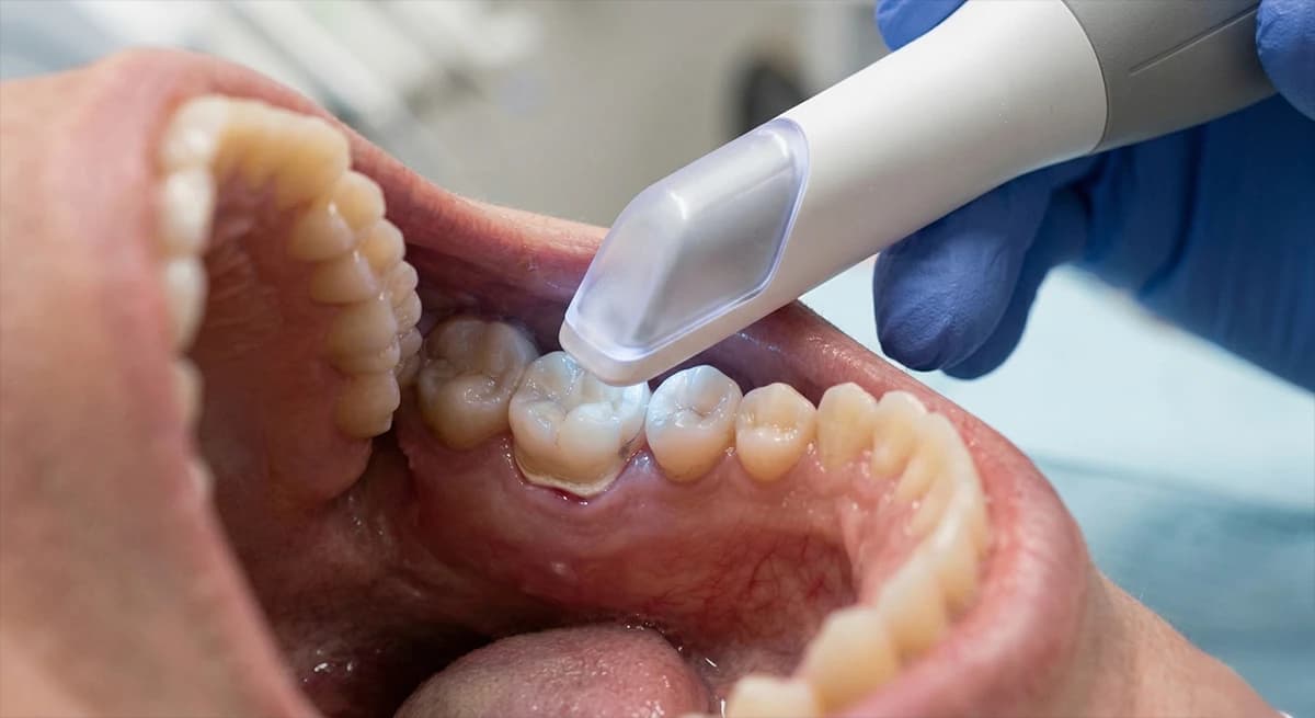 Intraoral scanner capturing precise digital impressions for whitening tray fabrication.