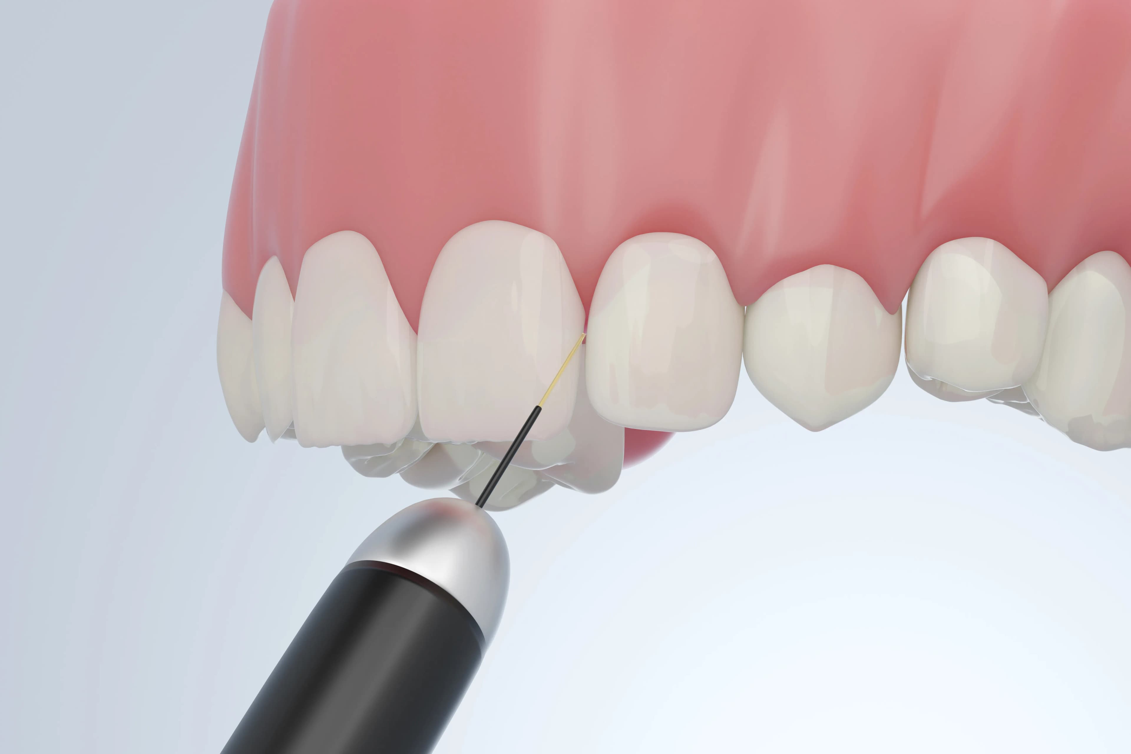 Dental Contouring treatment at Maypole Dental Surgery