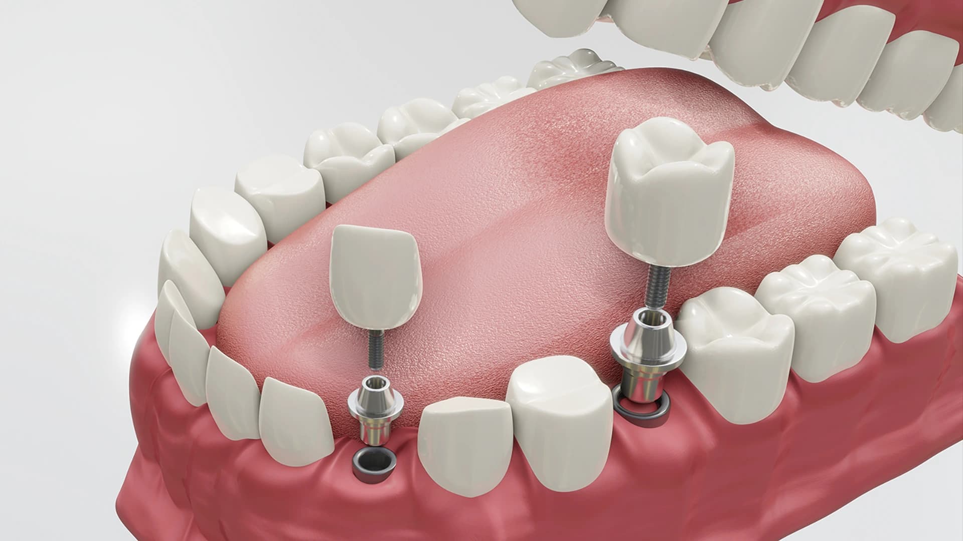 Implants treatment at Maypole Dental Surgery