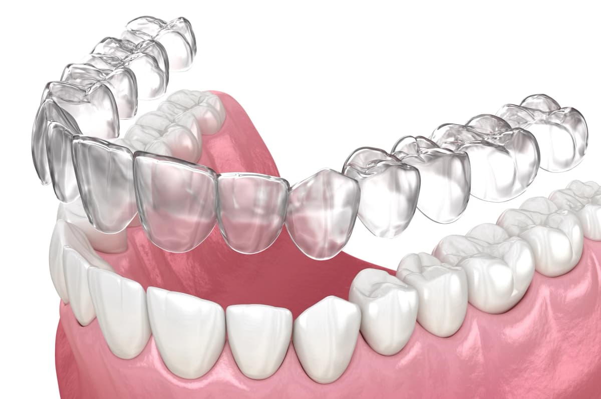 Invisalign