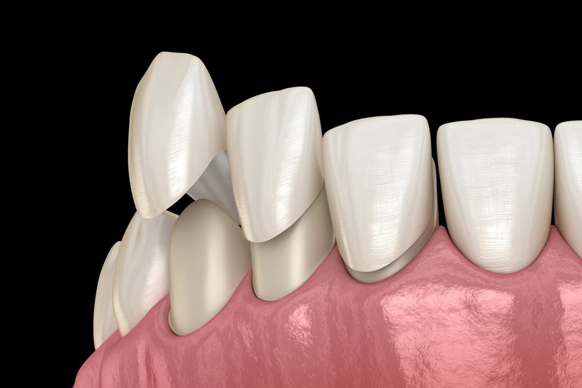 Veneers