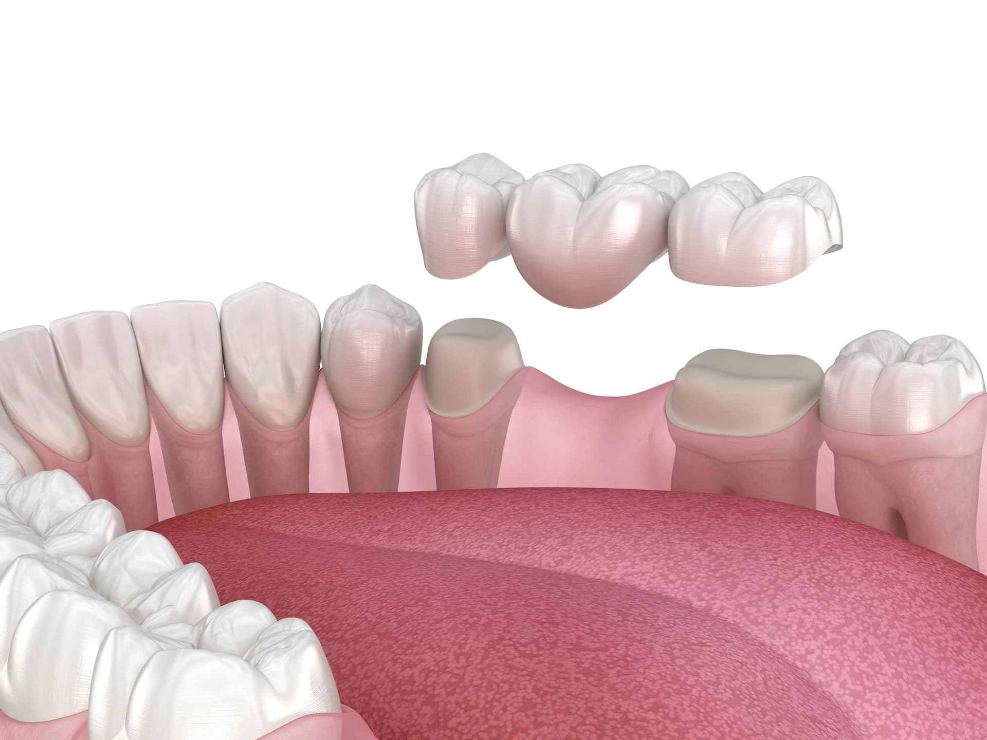 Bridges treatment at Maypole Dental Surgery