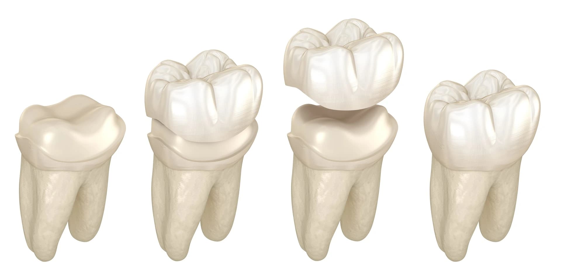 Crowns treatment at Maypole Dental Surgery
