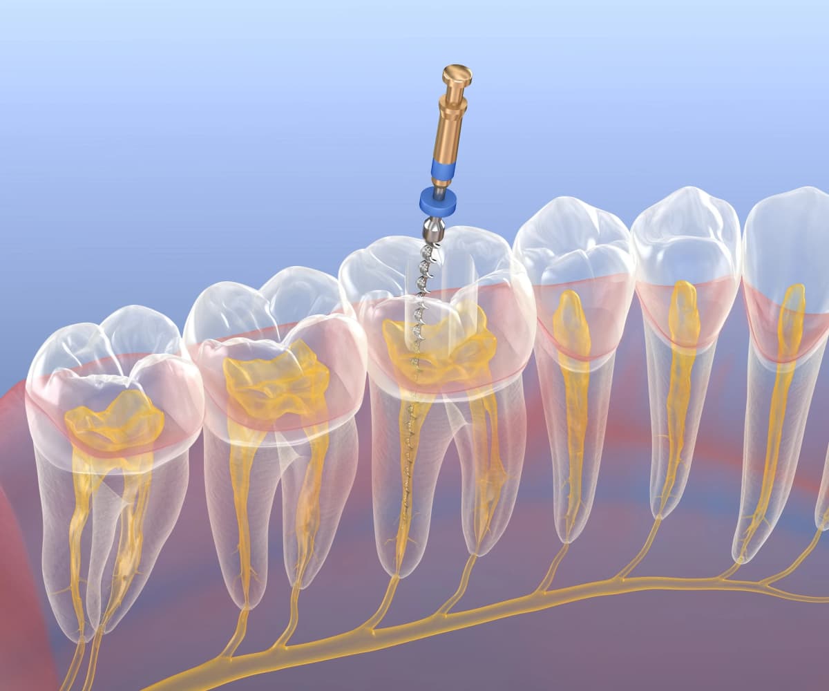 Root Canal