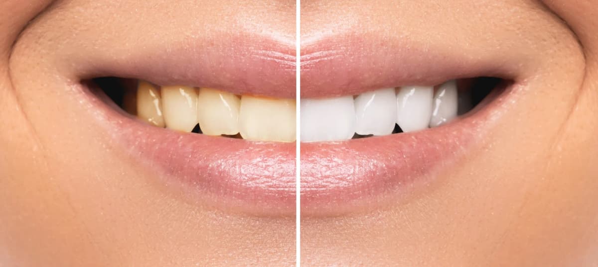 Tooth Whitening