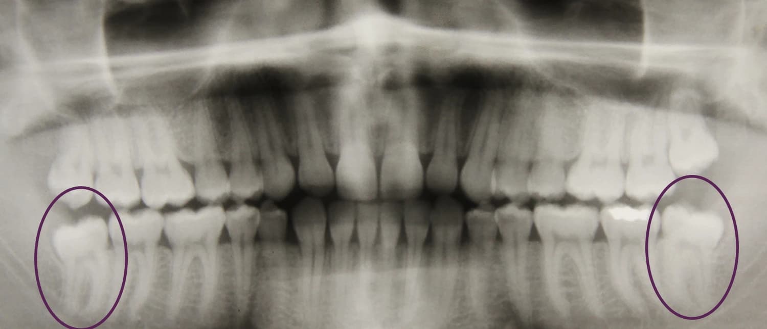 Digital X-ray showing wisdom tooth root morphology for pre-operative surgical planning.