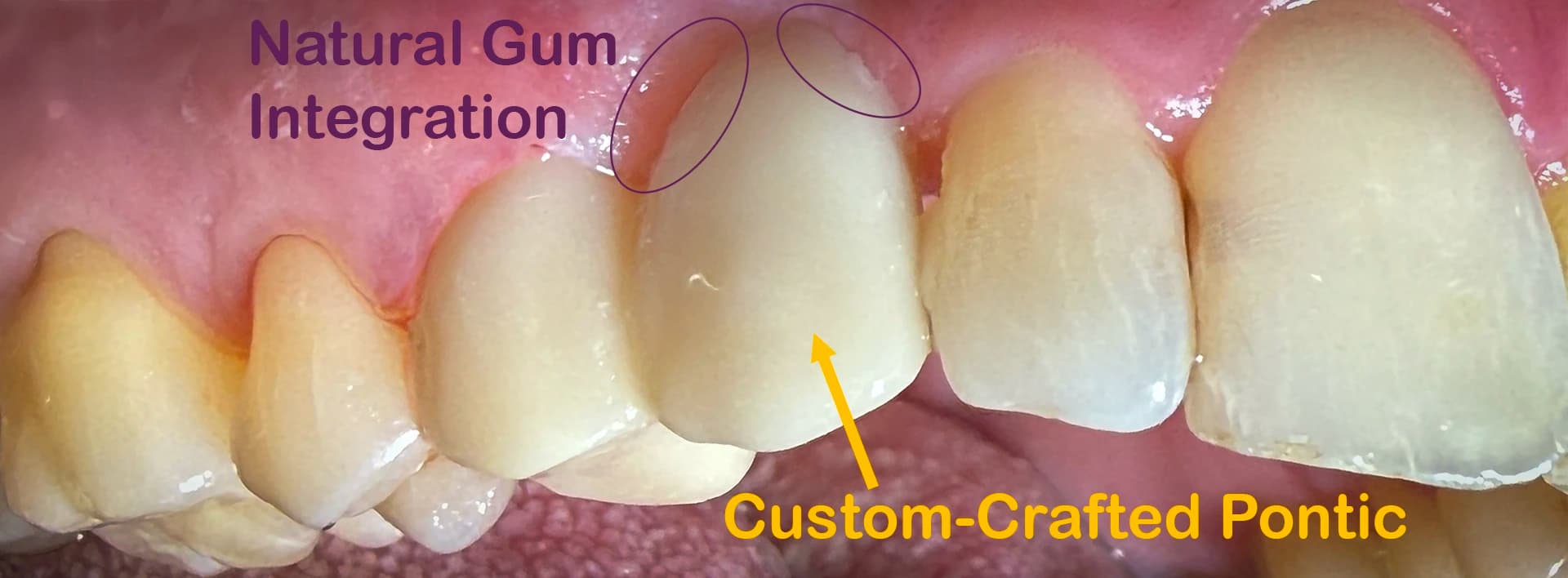 Final result of a 3-unit porcelain dental bridge showing the custom-crafted pontic and seamless gum integration at Maypole Dental