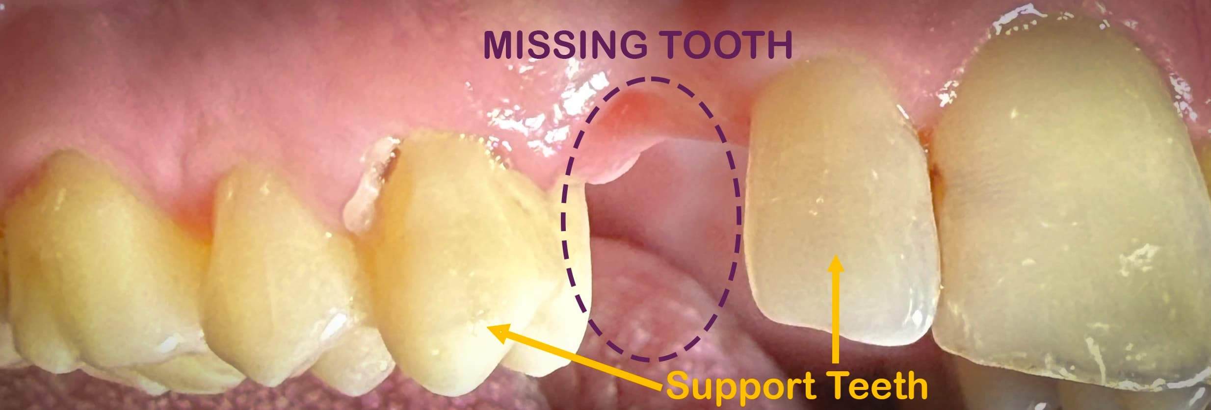 Educational dental diagram showing a missing tooth gap and the support abutment teeth required for a bridge at Maypole Dental