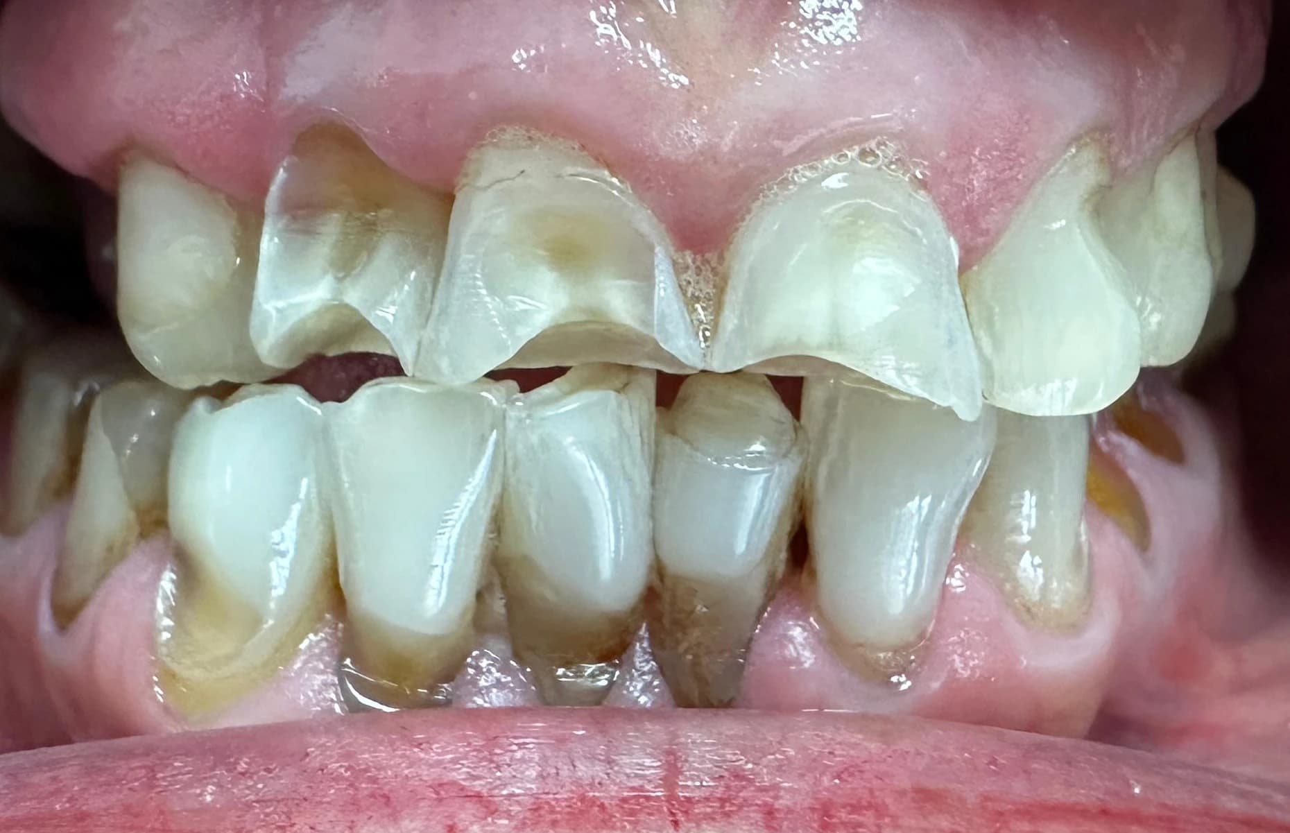 Before: Before and after composite bonding and teeth whitening transformation showing restored tooth structure and natural smile.