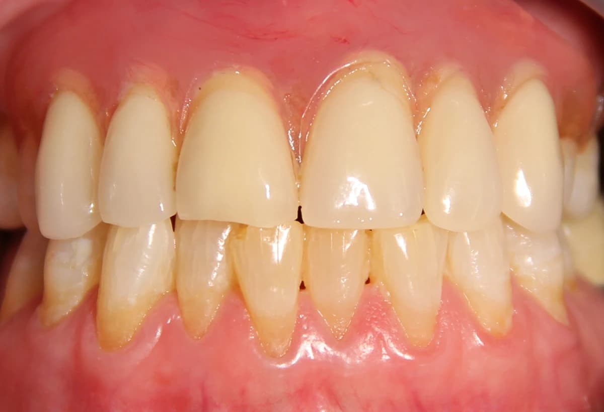 After: Before and after denture transformation showing full smile restoration at Maypole Dentistry.