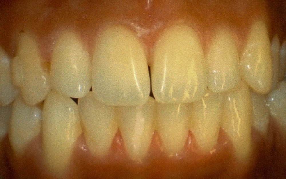 After: Invisalign before and after results for severe lower crowding and tooth rotation correction.
