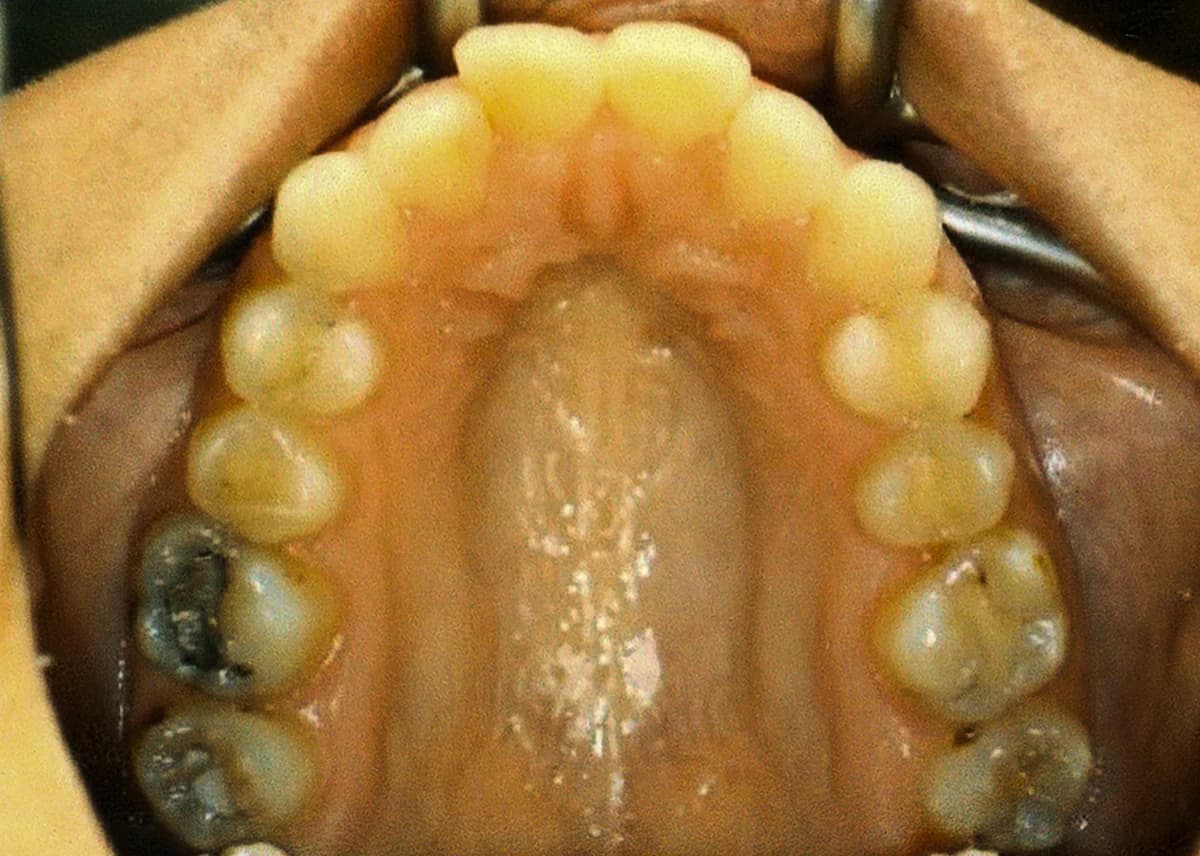 Clinical view of upper palate before Invisalign palatal expansion.