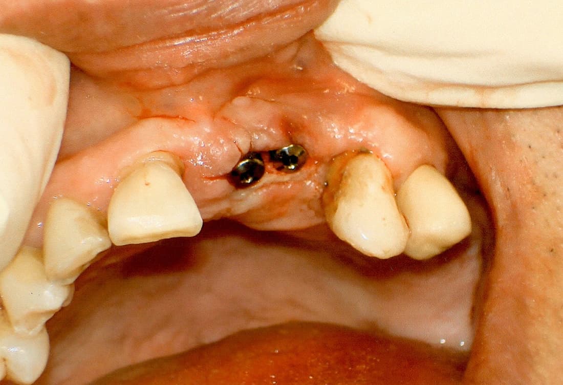 Clinical view of dual dental implant fixtures fitted into the upper jawbone.