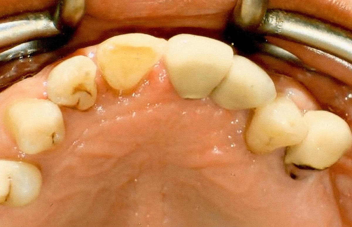 Internal view of completed dental implant crowns showing seamless gum integration.