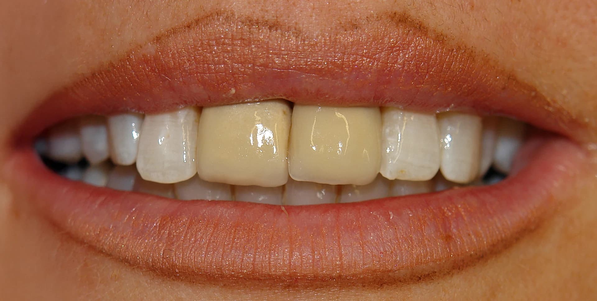 Before: Before and after porcelain veneers for internal staining and spacing correction at Maypole Dentistry.