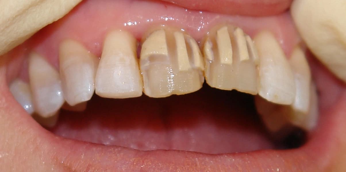 Minimal intervention veneer preparation showing conservative depth-cutting technique.