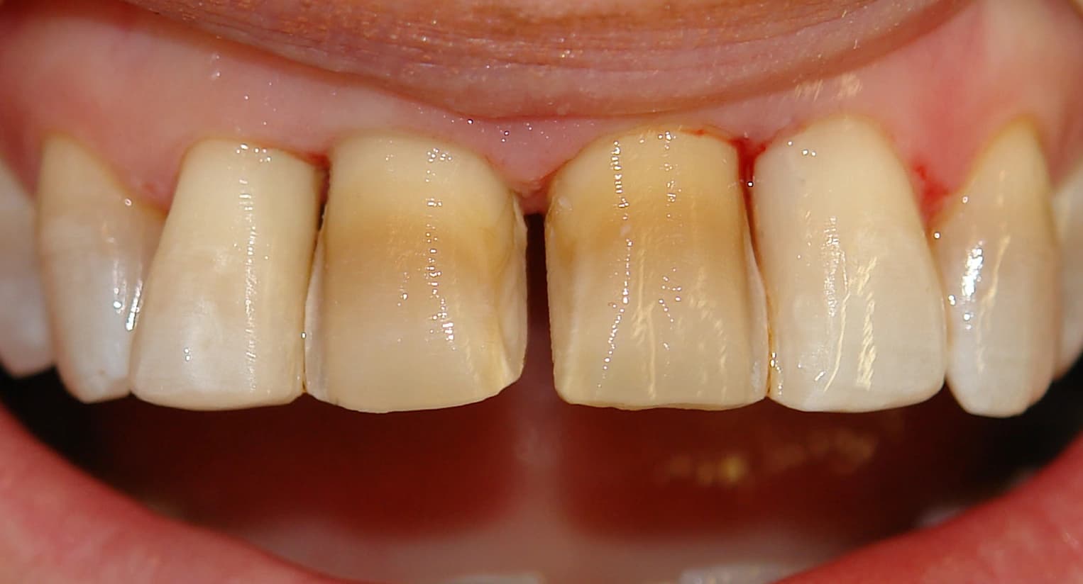 High-precision veneer margins showing refined tooth preparation for porcelain bonding.