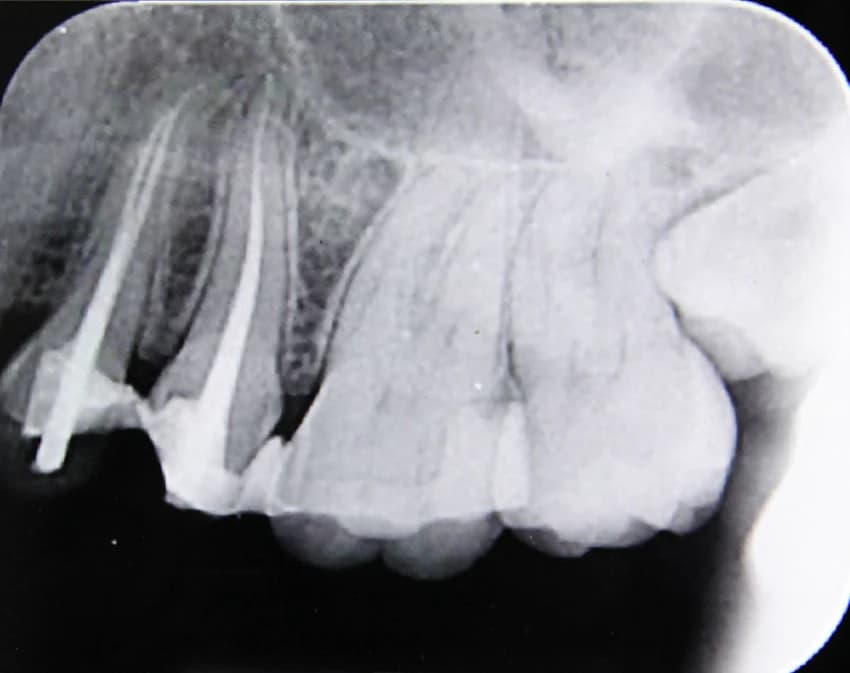 After: Clinical X-ray showing root canal therapy with internal reinforcement posts for multi-tooth restoration.