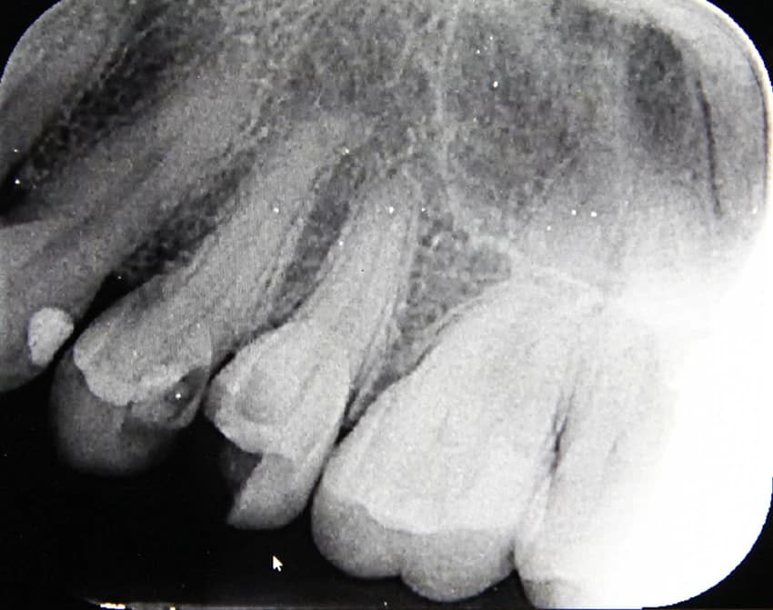 Before: Clinical X-ray showing root canal therapy with internal reinforcement posts for multi-tooth restoration.