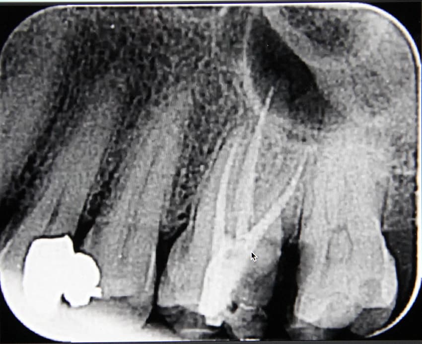 After: Before and after X-ray of a complex molar root canal treatment showing successful canal sealing at Maypole Dentistry.