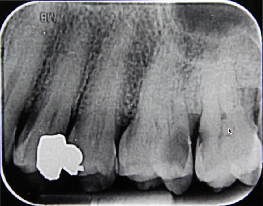 Before: Before and after X-ray of a complex molar root canal treatment showing successful canal sealing at Maypole Dentistry.