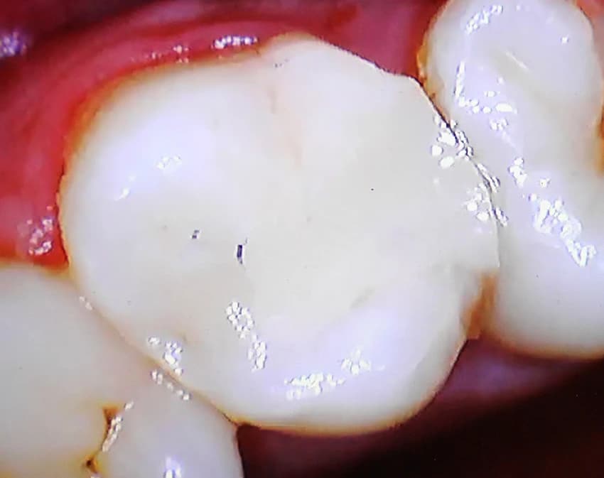After: Before and after comparison of dark amalgam silver filling replaced with a seamless white composite restoration.