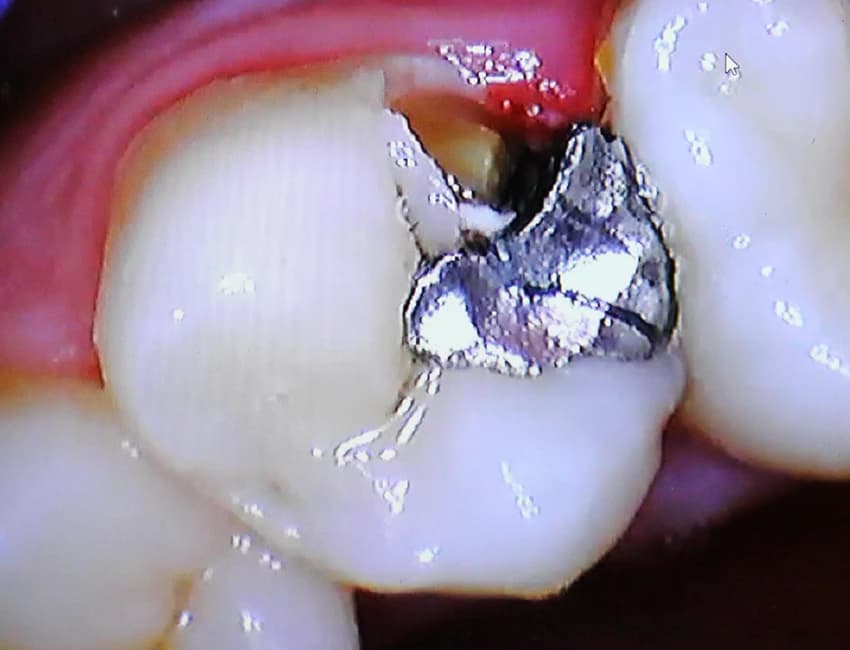 Before: Before and after comparison of dark amalgam silver filling replaced with a seamless white composite restoration.