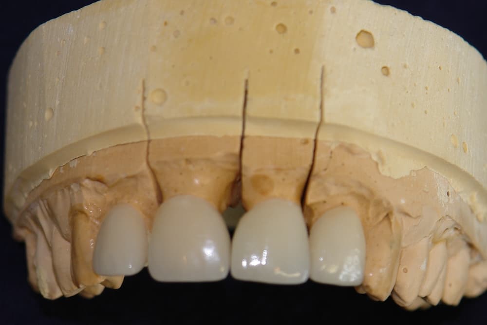 Veneer master model showing hand-finished porcelain restorations on precision stone cast for laboratory verification.